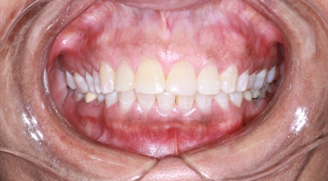 Restored natural smile after cosmetic bonding at Serenity Dental