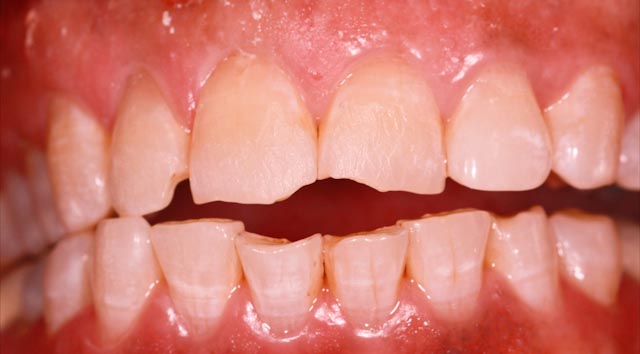 Smile before cosmetic bonding at Serenity Dental
