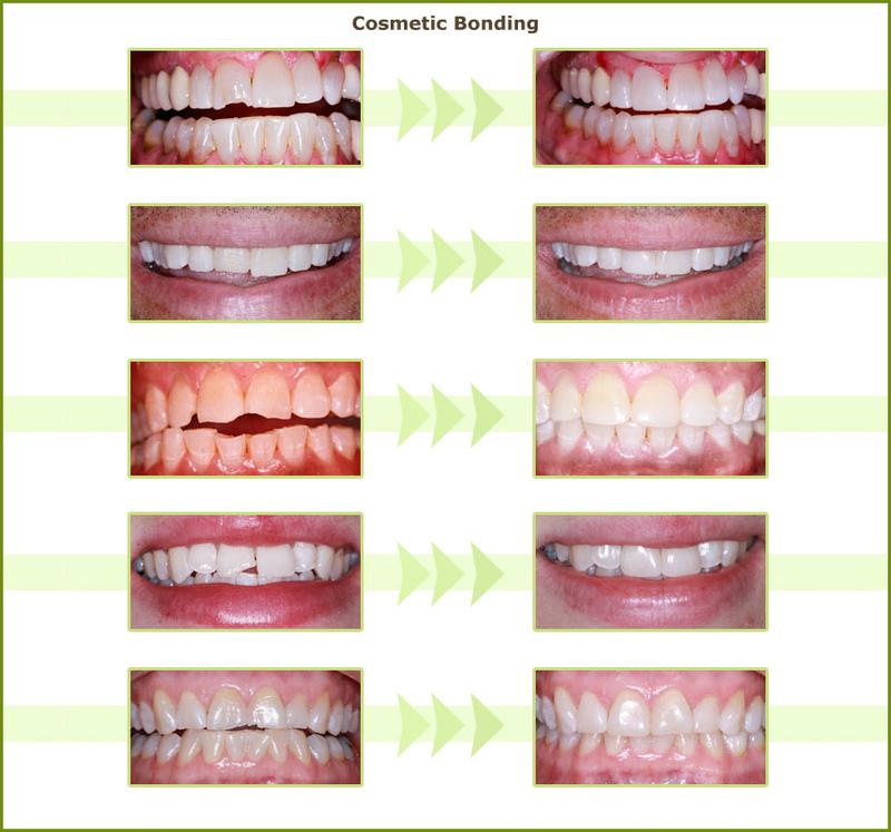 Cosmetic bonding before and after