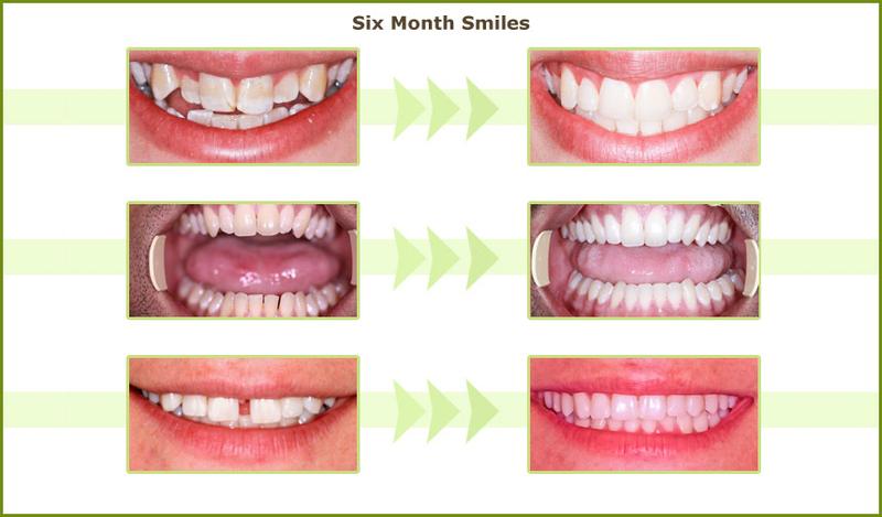 Six Month Smiles before and after