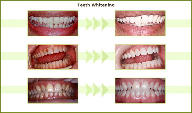 Laser teeth whitening before and after