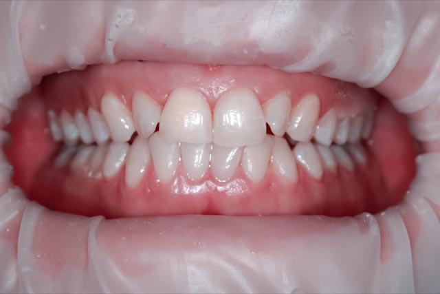 Teeth after laser whitening at Serenity Dental — visibly brighter