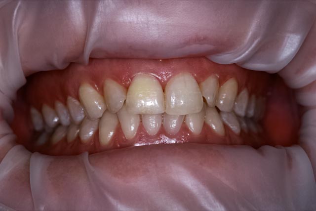 Teeth before laser whitening at Serenity Dental