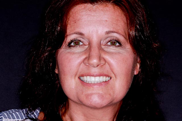 Kathy's straightened smile after Six Month Smiles
