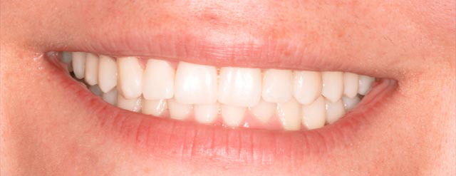 Straightened smile after Six Month Smiles treatment