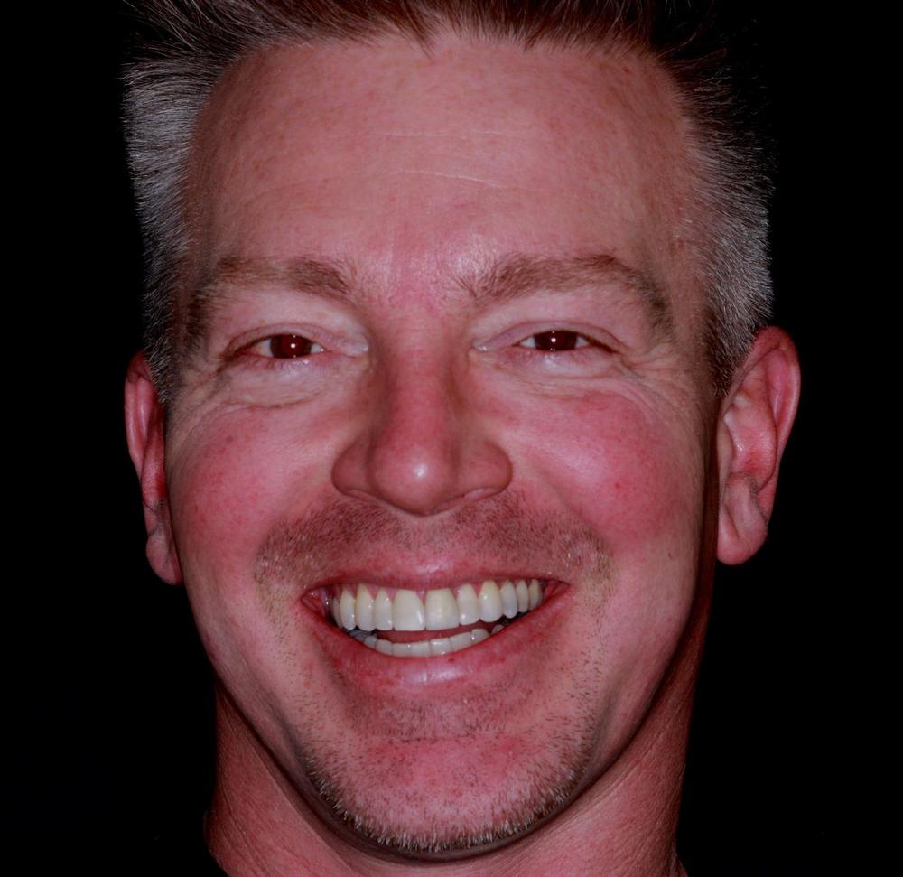 Russ's straightened smile after Six Month Smiles