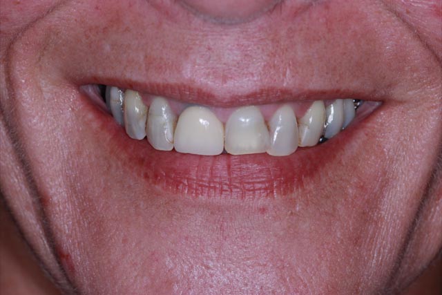 Smile before porcelain veneers at Serenity Dental