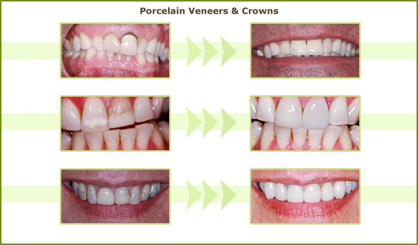 Real before and after porcelain veneers and crowns results — three patient cases