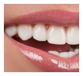 Dental crown restoration on a prepared tooth