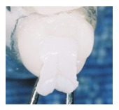 Porcelain inlay restoration on a molar
