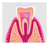 Diagram of root canal treatment inside a tooth